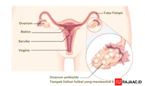 PCOS dan Kista Ovarium